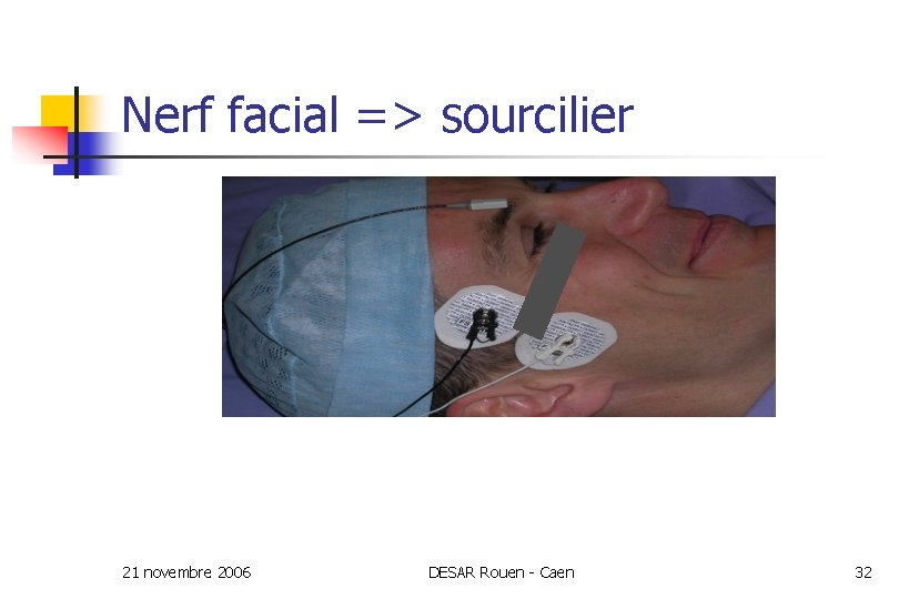 Nerf facial => sourcilier 21 novembre 2006 DESAR Rouen - Caen 32 