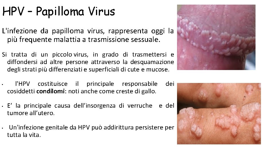 HPV – Papilloma Virus L'infezione da papilloma virus, rappresenta oggi la più frequente malattia