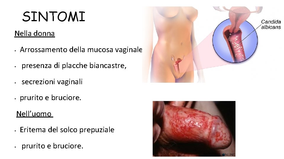 SINTOMI Nella donna • Arrossamento della mucosa vaginale, • presenza di placche biancastre, •