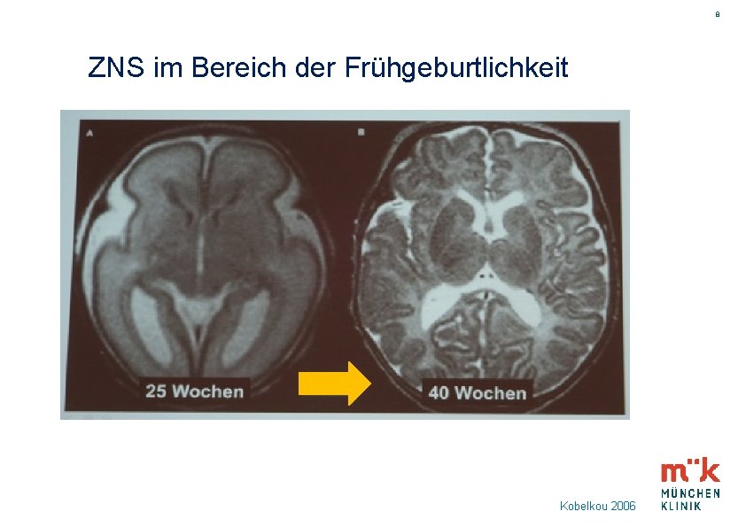 8 ZNS im Bereich der Frühgeburtlichkeit Kobelkou 2006 