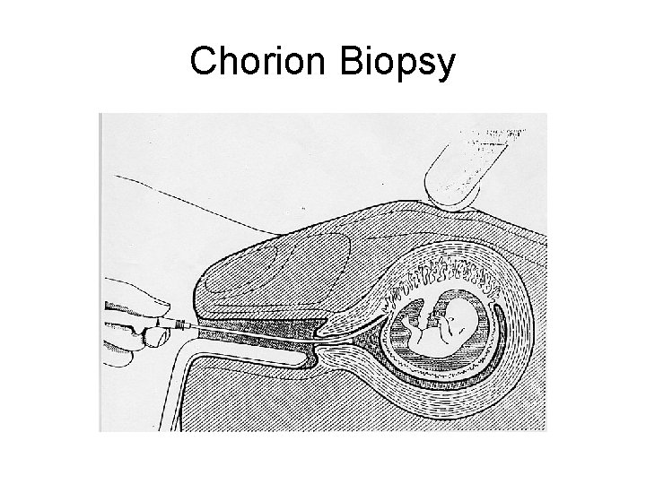 Chorion Biopsy 