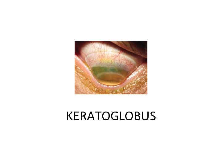 KERATOGLOBUS 