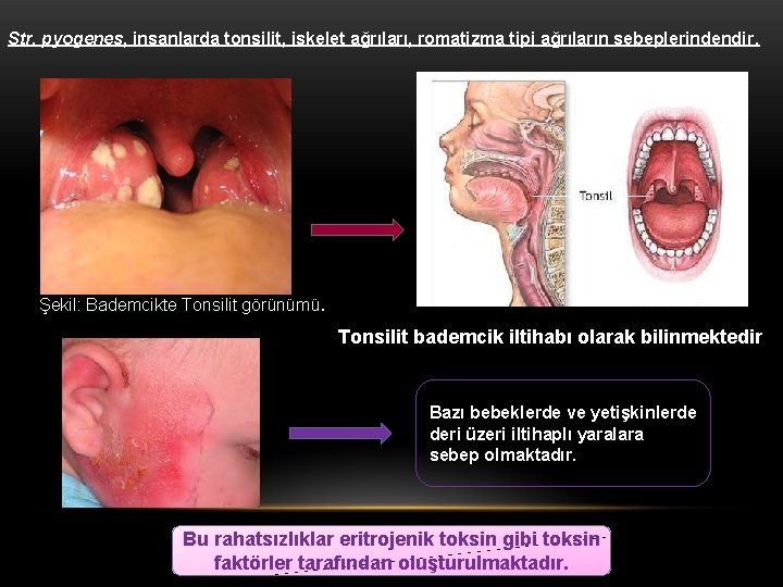 Str. pyogenes, insanlarda tonsilit, iskelet ağrıları, romatizma tipi ağrıların sebeplerindendir. Şekil: Bademcikte Tonsilit görünümü.