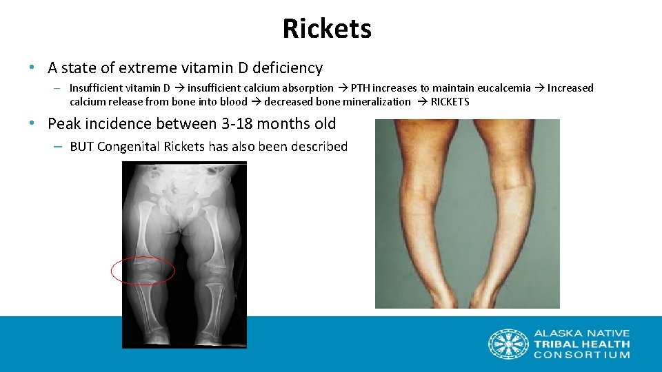 Prevention of Rickets and Vitamin D Deficiency in