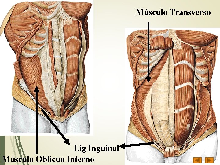 Músculo Transverso Lig Inguinal Músculo Oblicuo Interno 