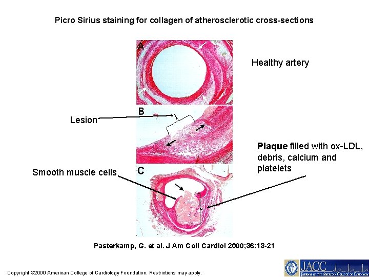 Picro Sirius staining for collagen of atherosclerotic cross-sections Healthy artery Lesion Smooth muscle cells
