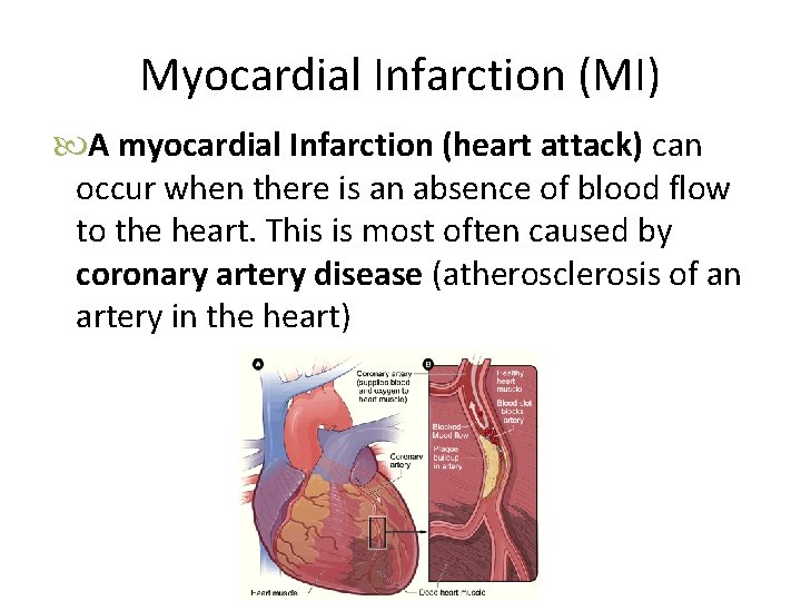 Myocardial Infarction (MI) A myocardial Infarction (heart attack) can occur when there is an