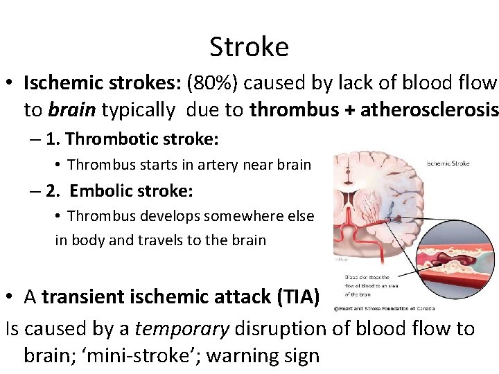 Stroke • Ischemic strokes: (80%) caused by lack of blood flow to brain typically