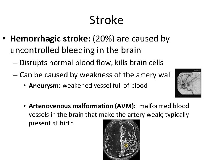 Stroke • Hemorrhagic stroke: (20%) are caused by uncontrolled bleeding in the brain –