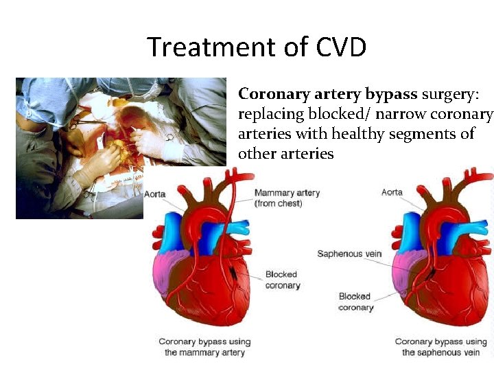 Treatment of CVD Coronary artery bypass surgery: replacing blocked/ narrow coronary arteries with healthy