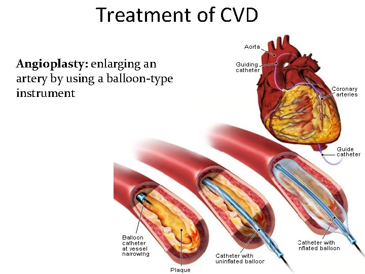 Treatment of CVD Angioplasty: enlarging an artery by using a balloon-type instrument 