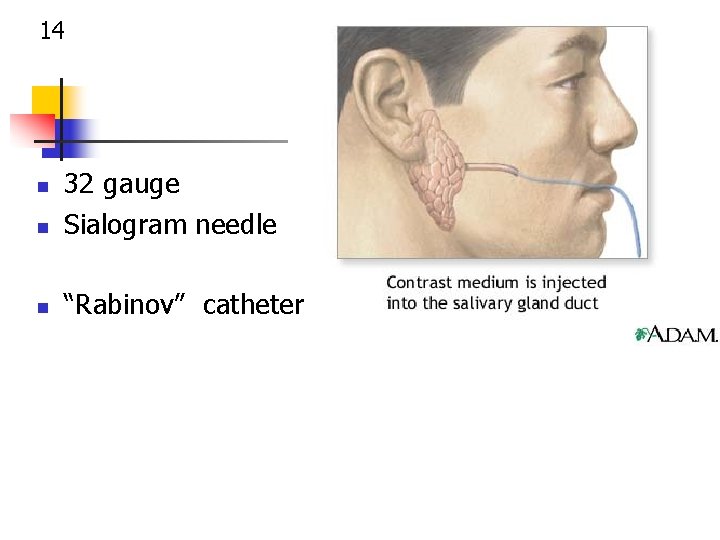 14 n 32 gauge Sialogram needle n “Rabinov” catheter n 