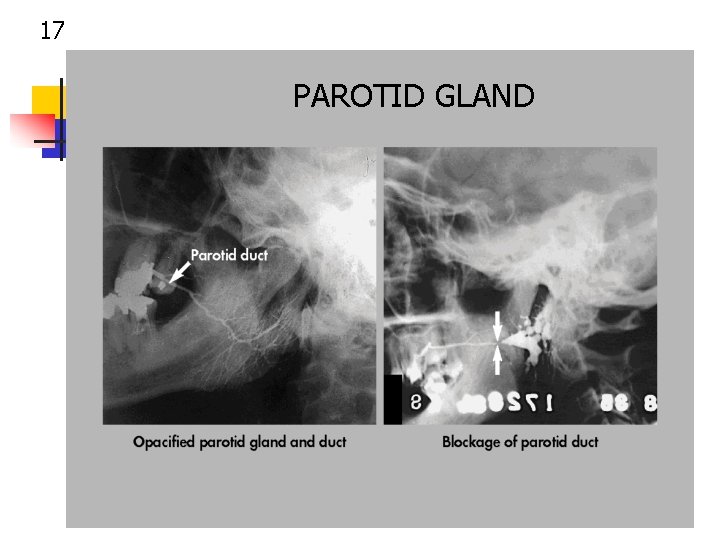 17 PAROTID GLAND 