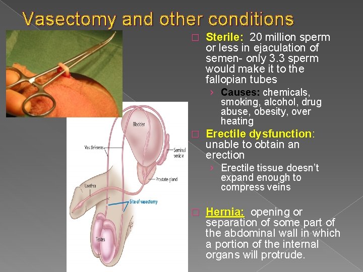 Vasectomy and other conditions � Sterile: 20 million sperm or less in ejaculation of Vasectomy and other conditions � Sterile: 20 million sperm or less in ejaculation of