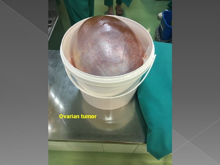 Ovarian tumor Ovarian tumor