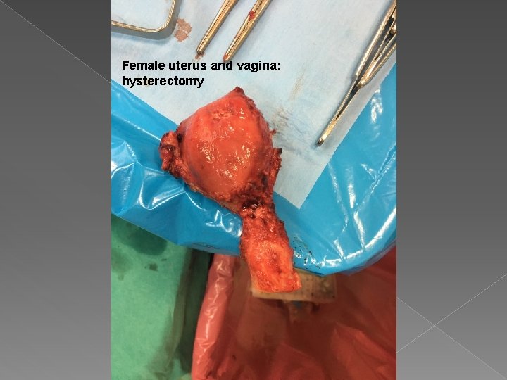 Female uterus and vagina: hysterectomy Female uterus and vagina: hysterectomy