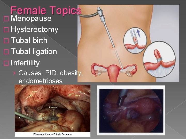 Female Topics � Menopause � Hysterectomy � Tubal birth � Tubal ligation � Infertility Female Topics � Menopause � Hysterectomy � Tubal birth � Tubal ligation � Infertility