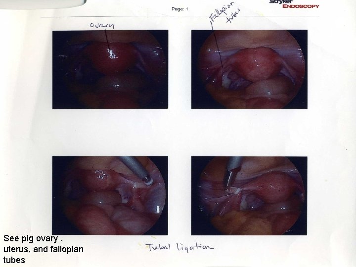 See pig ovary , uterus, and fallopian tubes See pig ovary , uterus, and fallopian tubes