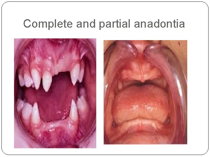 Complete and partial anadontia 