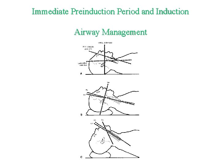 Immediate Preinduction Period and Induction Airway Management 