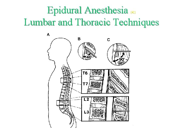 Epidural Anesthesia Lumbar and Thoracic Techniques (41) 