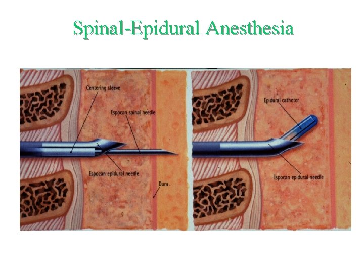Spinal-Epidural Anesthesia 