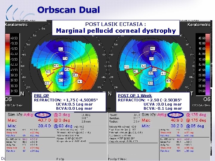 Orbscan Dual Corneal Flap POST LASIK ECTASIA : Marginal pellucid corneal dystrophy OCT PRE