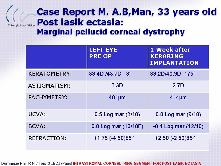 Case Report M. A. B, Man, 33 years old Post lasik ectasia: Marginal pellucid