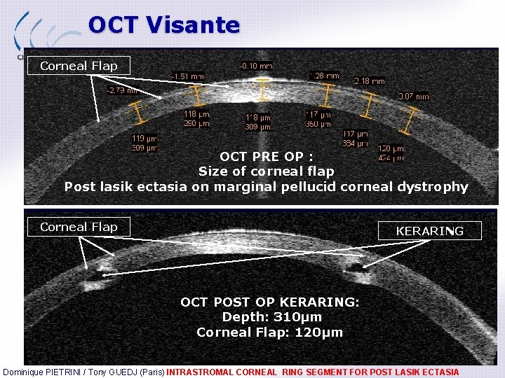 OCT Visante Corneal Flap OCT PRE OP : Size of corneal flap Post lasik