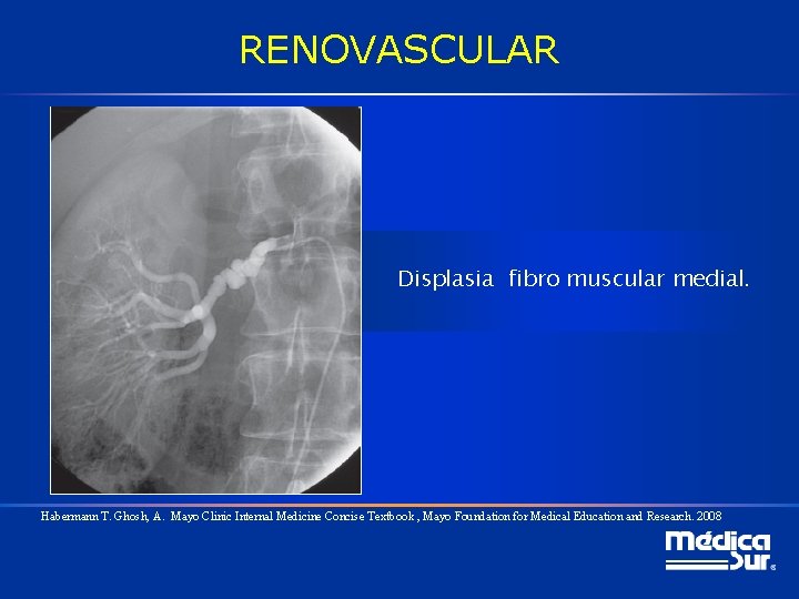 RENOVASCULAR Displasia fibro muscular medial. Habermann T. Ghosh, A. Mayo Clinic Internal Medicine Concise