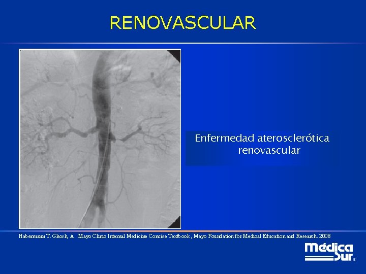 RENOVASCULAR Enfermedad aterosclerótica renovascular Habermann T. Ghosh, A. Mayo Clinic Internal Medicine Concise Textbook