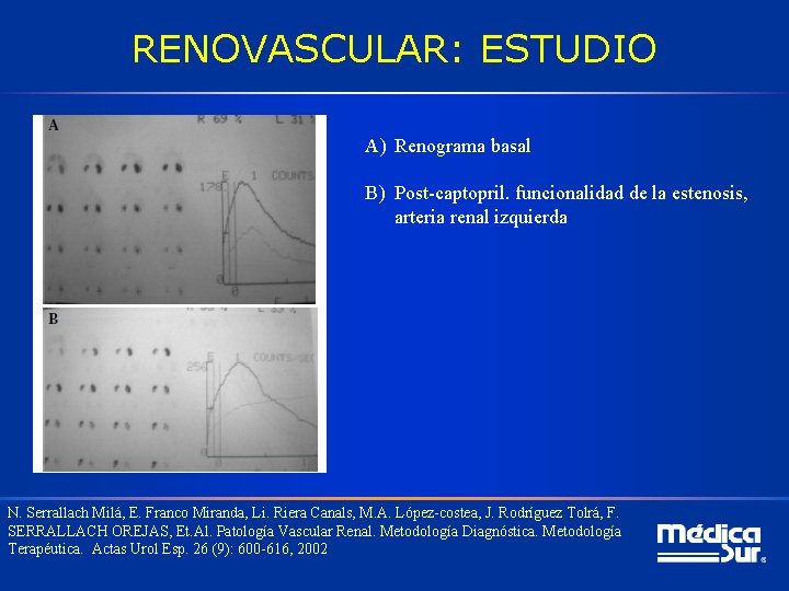 RENOVASCULAR: ESTUDIO A) Renograma basal B) Post-captopril. funcionalidad de la estenosis, arteria renal izquierda