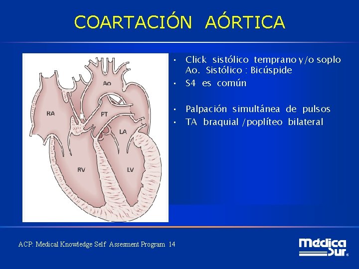 COARTACIÓN AÓRTICA • Click sistólico temprano y/o soplo Ao. Sistólico : Bicúspide • S