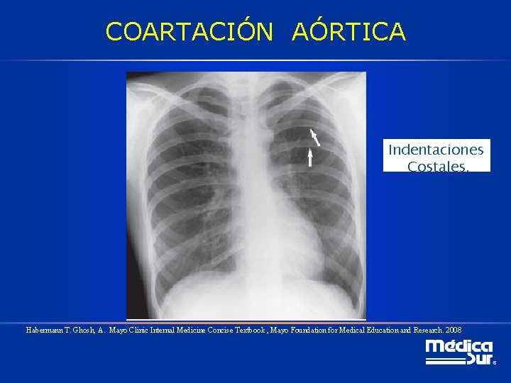 COARTACIÓN AÓRTICA Indentaciones Costales. Habermann T. Ghosh, A. Mayo Clinic Internal Medicine Concise Textbook