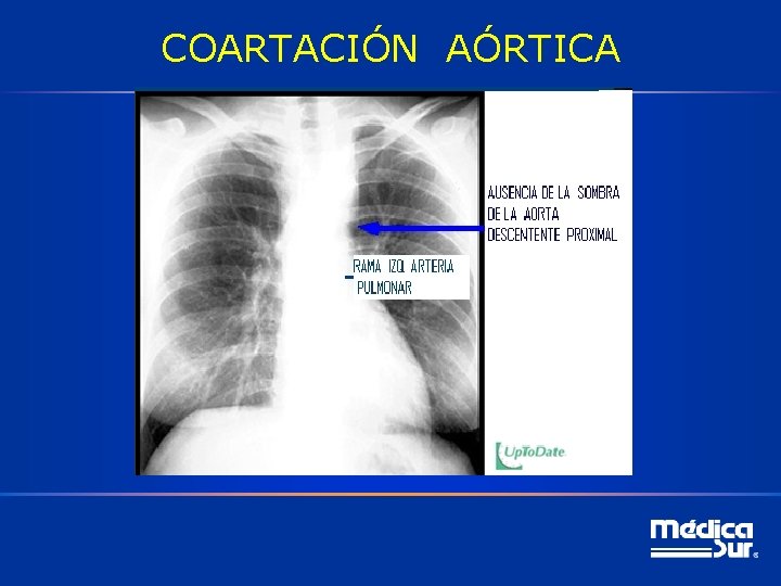 COARTACIÓN AÓRTICA 