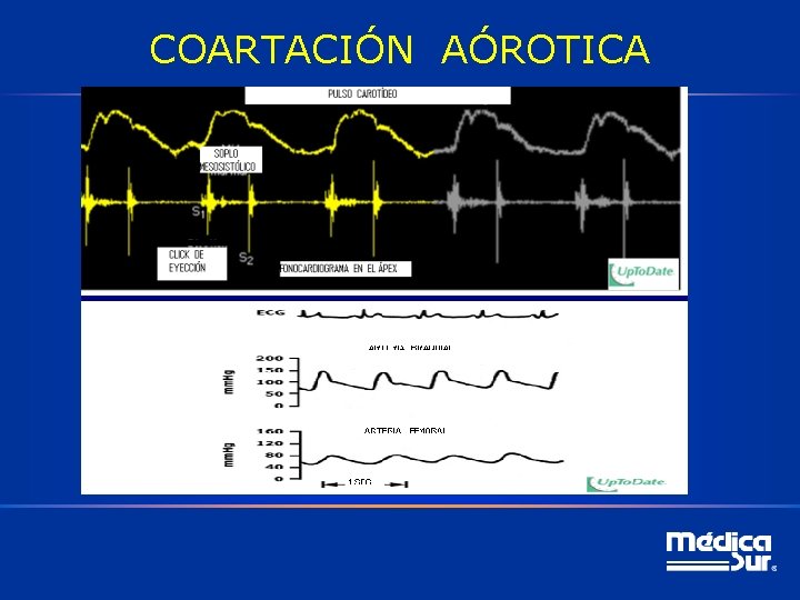 COARTACIÓN AÓROTICA 