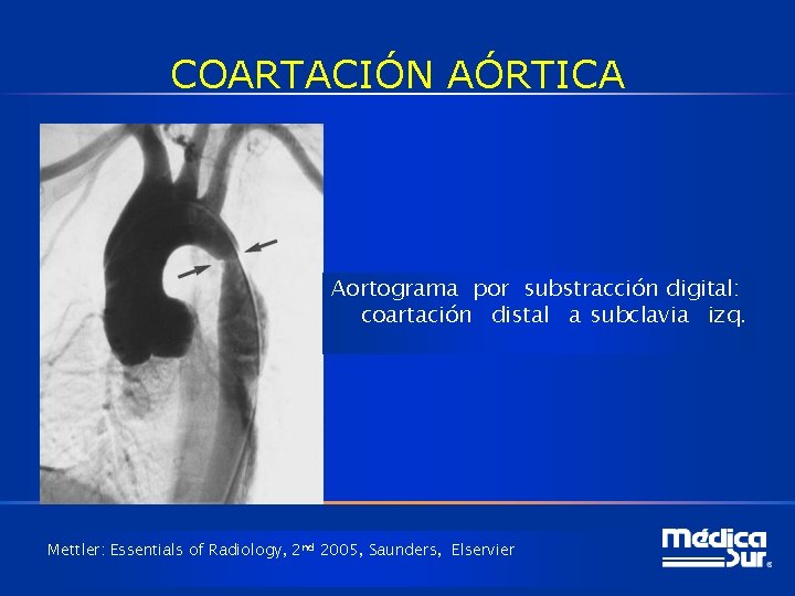 COARTACIÓN AÓRTICA Aortograma por substracción digital: coartación distal a subclavia izq. Mettler: Essentials of