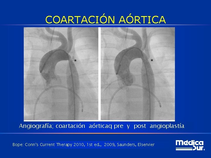 COARTACIÓN AÓRTICA Angiografía; coartación aórticaq pre y post angioplastía Bope: Conn's Current Therapy 2010,