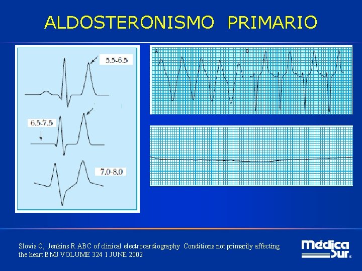 ALDOSTERONISMO PRIMARIO Slovis C, Jenkins R ABC of clinical electrocardiography Conditions not primarily affecting