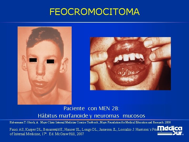 FEOCROMOCITOMA Paciente con MEN 2 B: Hábitus marfanoide y neuromas mucosos Habermann T. Ghosh,