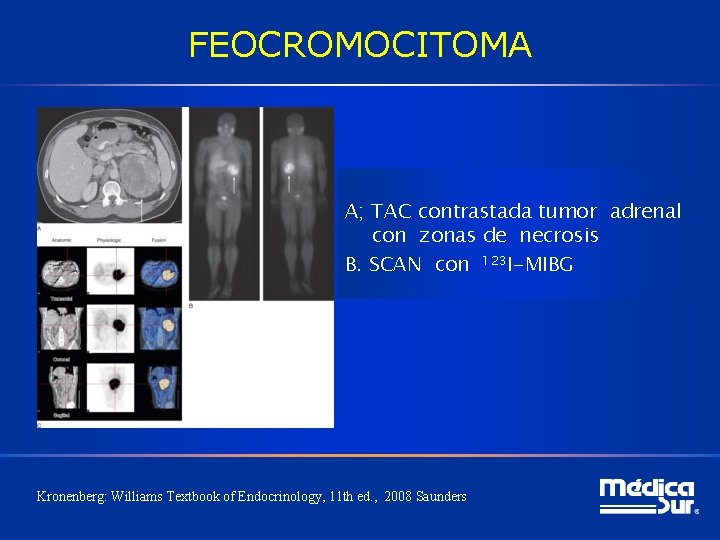 FEOCROMOCITOMA A; TAC contrastada tumor adrenal con zonas de necrosis B. SCAN con 123