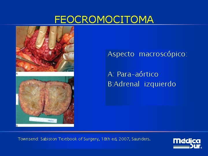 FEOCROMOCITOMA Aspecto macroscópico: A: Para-aórtico B: Adrenal izquierdo Townsend: Sabiston Textbook of Surgery, 18