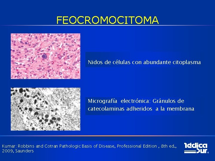 FEOCROMOCITOMA Nidos de células con abundante citoplasma Micrografía electrónica: Gránulos de catecolaminas adheridos a