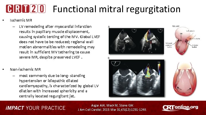 Functional mitral regurgitation • Ischemic MR – LV remodeling after myocardial infarction results in