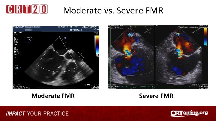 Moderate vs. Severe FMR Moderate FMR Severe FMR 