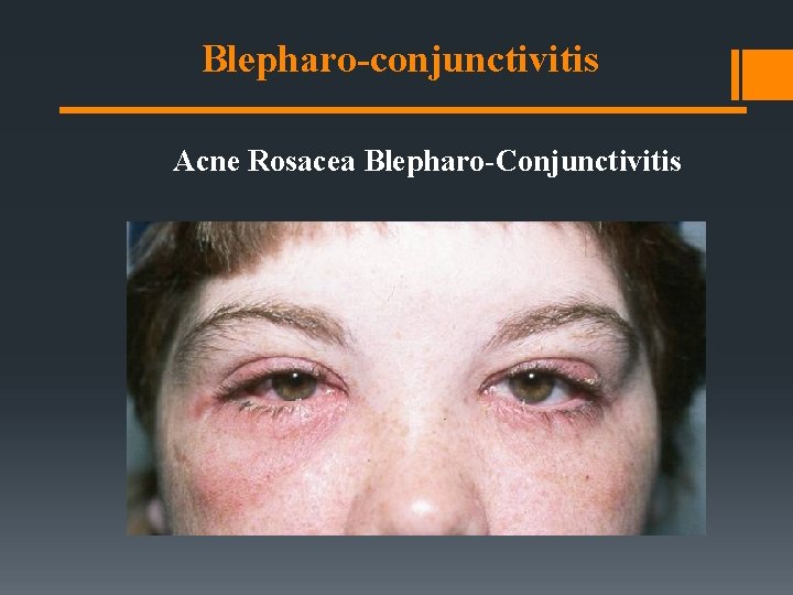 Blepharo-conjunctivitis Acne Rosacea Blepharo-Conjunctivitis 