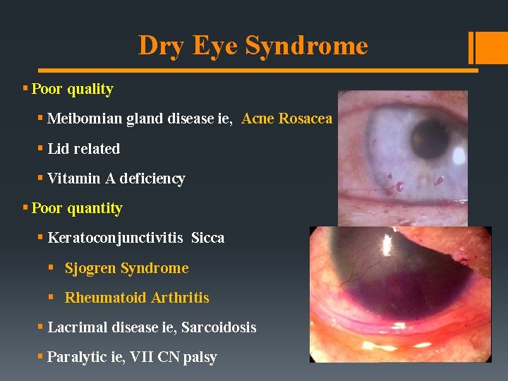 Dry Eye Syndrome § Poor quality § Meibomian gland disease ie, Acne Rosacea §