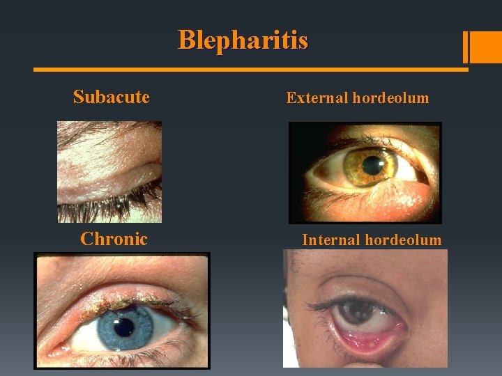 Blepharitis Subacute Chronic External hordeolum Internal hordeolum 