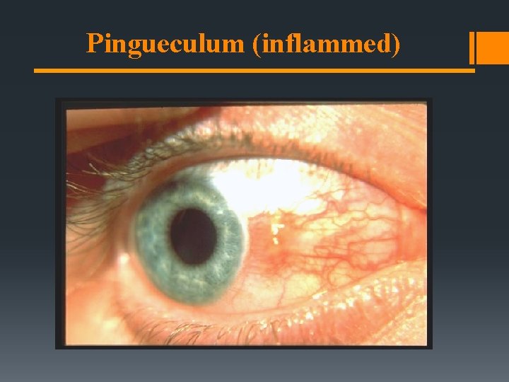 Pingueculum (inflammed) 