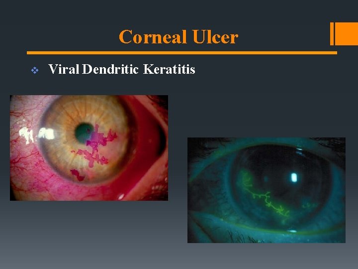 Corneal Ulcer v Viral Dendritic Keratitis 